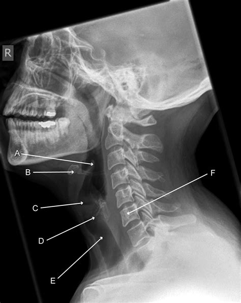 lateral soft tissue neck x ray.